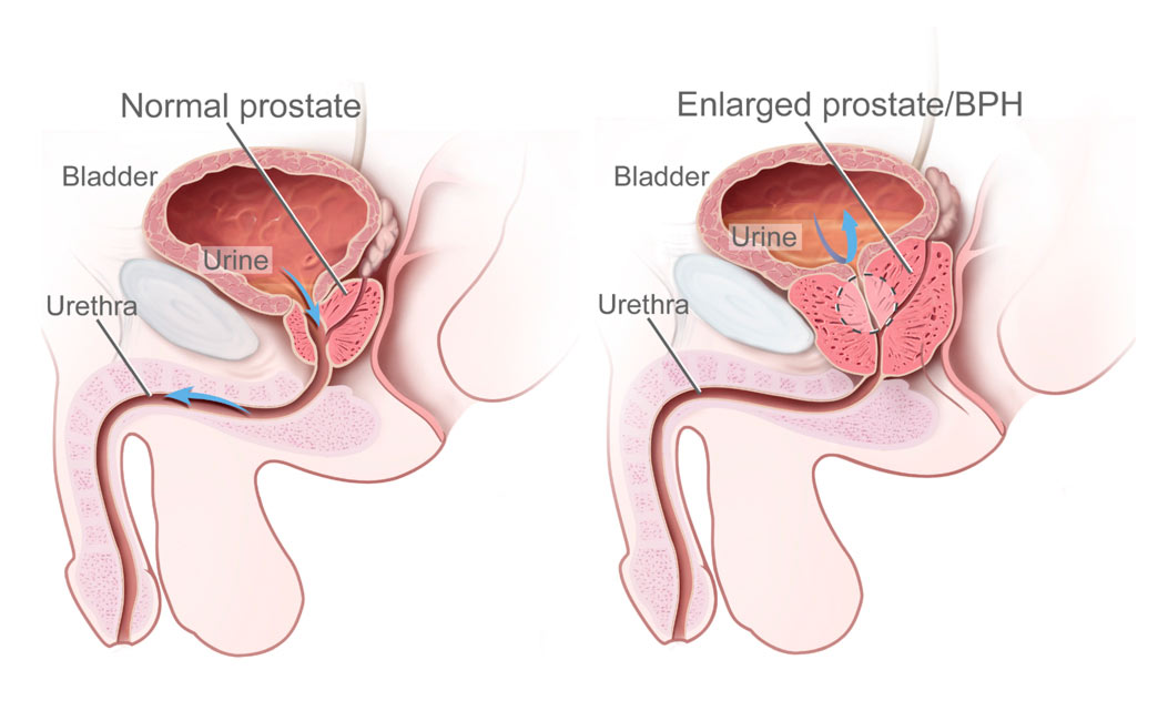 prostata ingrossata