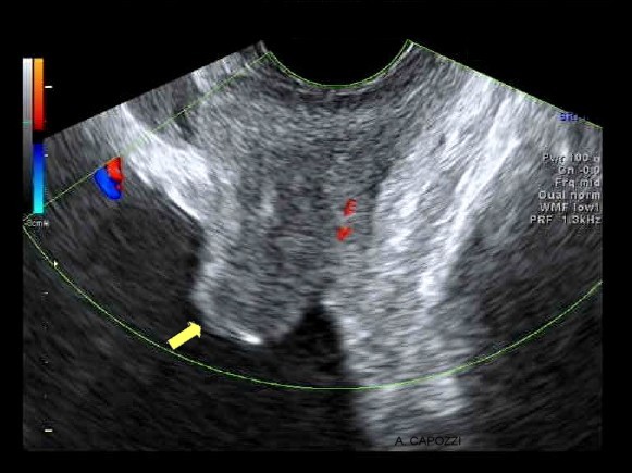 ecografia prostata post adenoma
