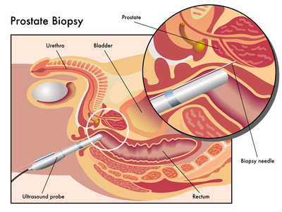 prostate biopsy