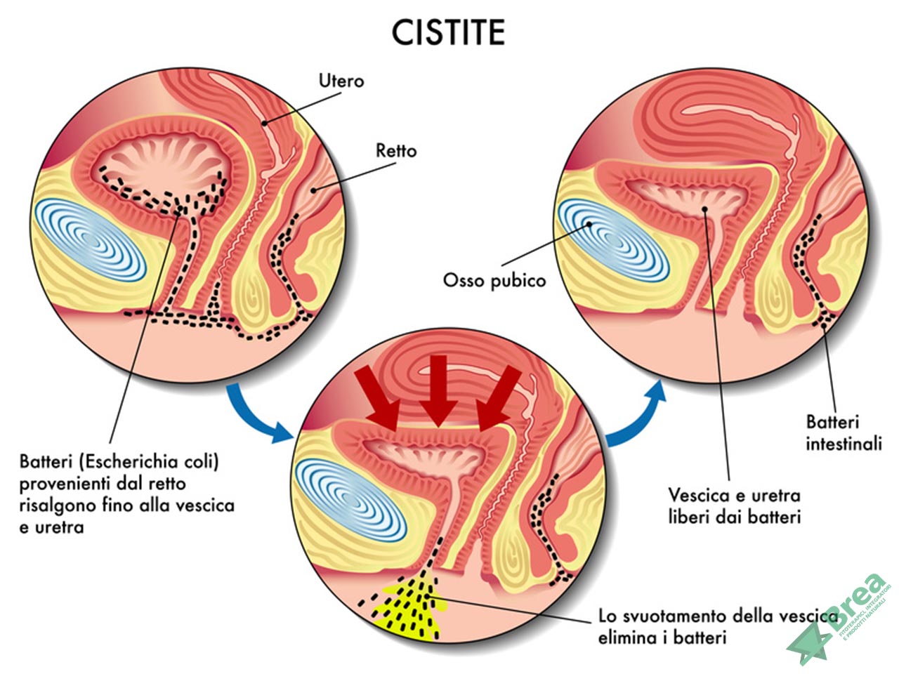 cistite schema