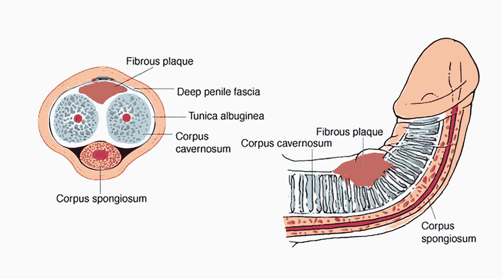 penile curvature surgery