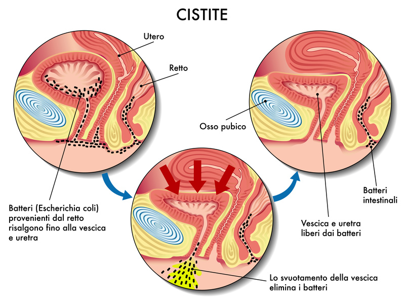 cistite schema funzionamento