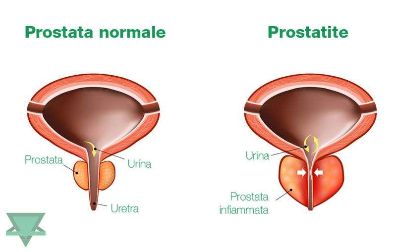 prostata normale infoammata