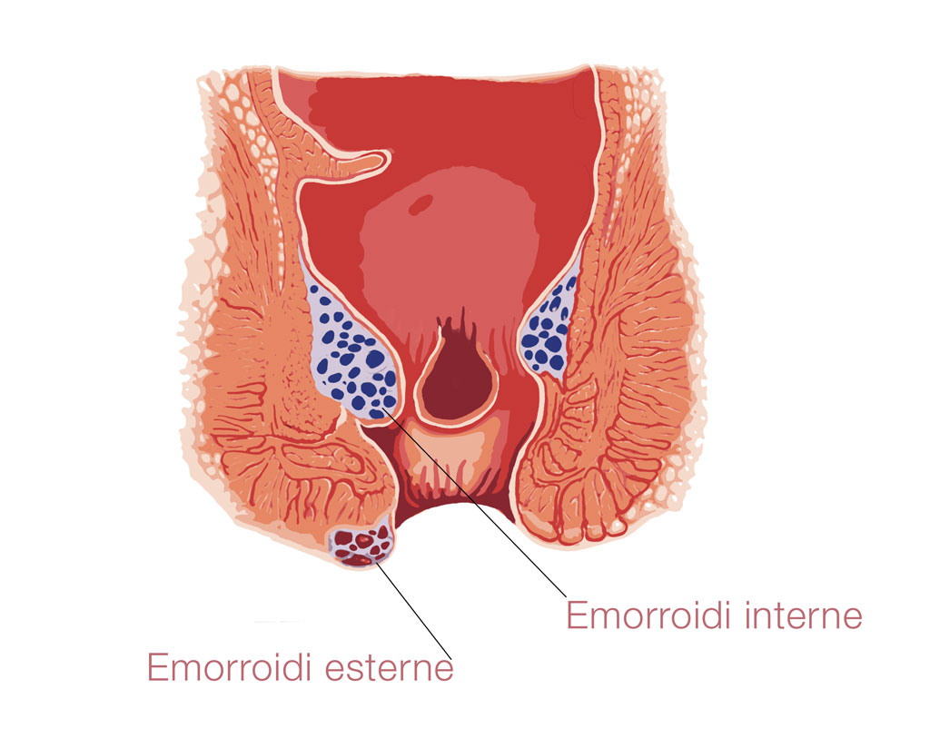 emorrodi schema