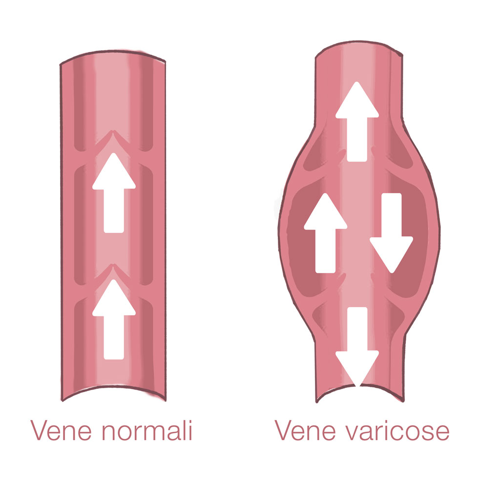 vene varicose